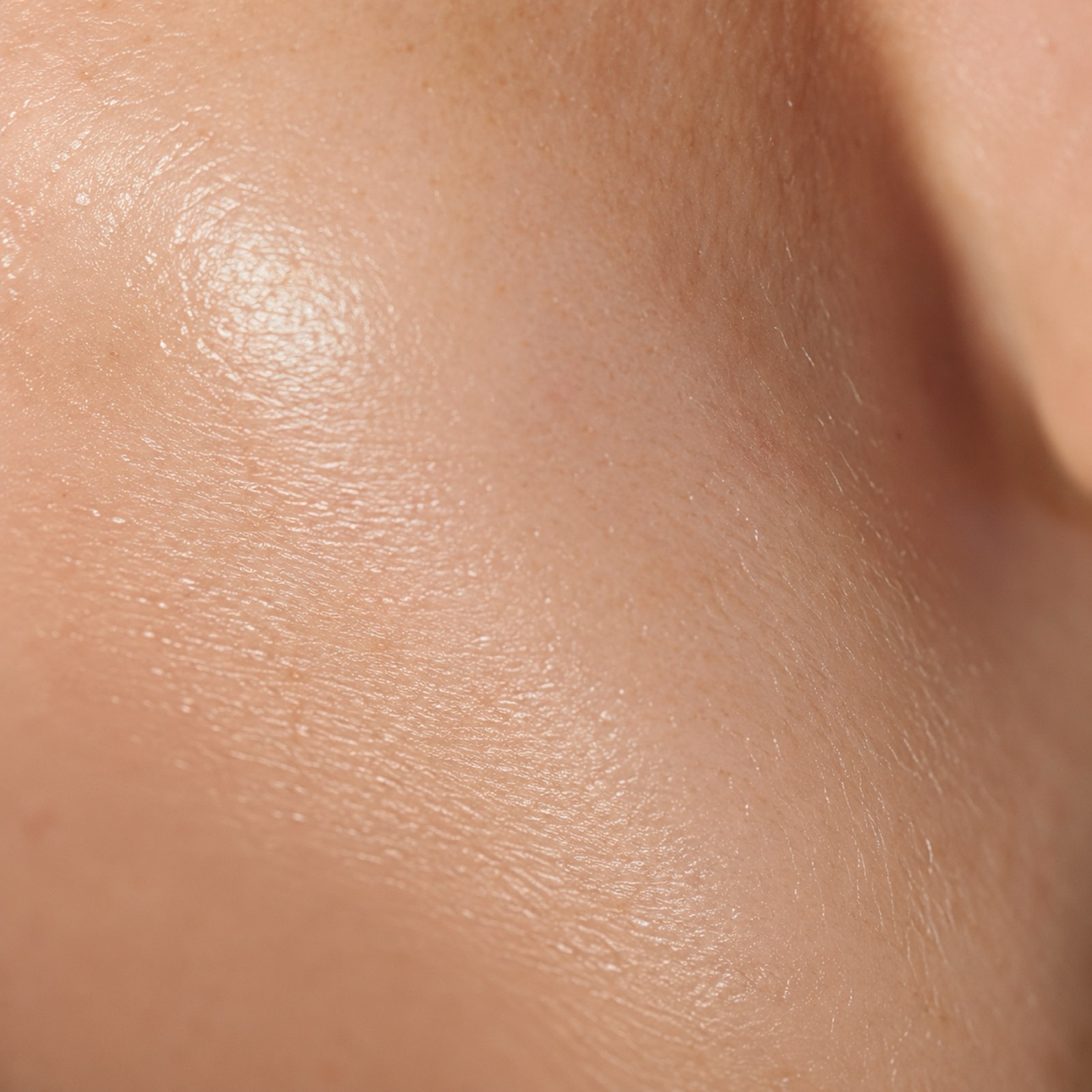 Enlarged pores & texture